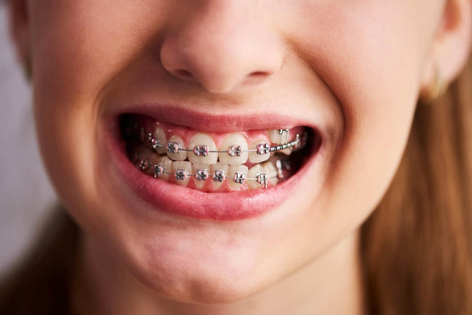 Is It True That Braces Weaken The Teeth? My Pedia Clinic