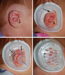 Infant Ear Molding