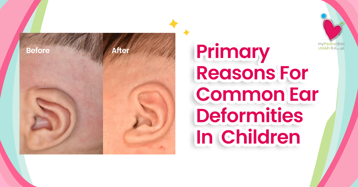 Primary Reasons For Common Ear Deformities In Children