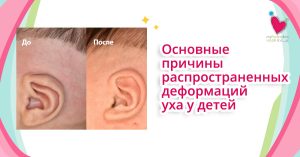 My Pedia Clinic - Main causes of common ear deformities in children