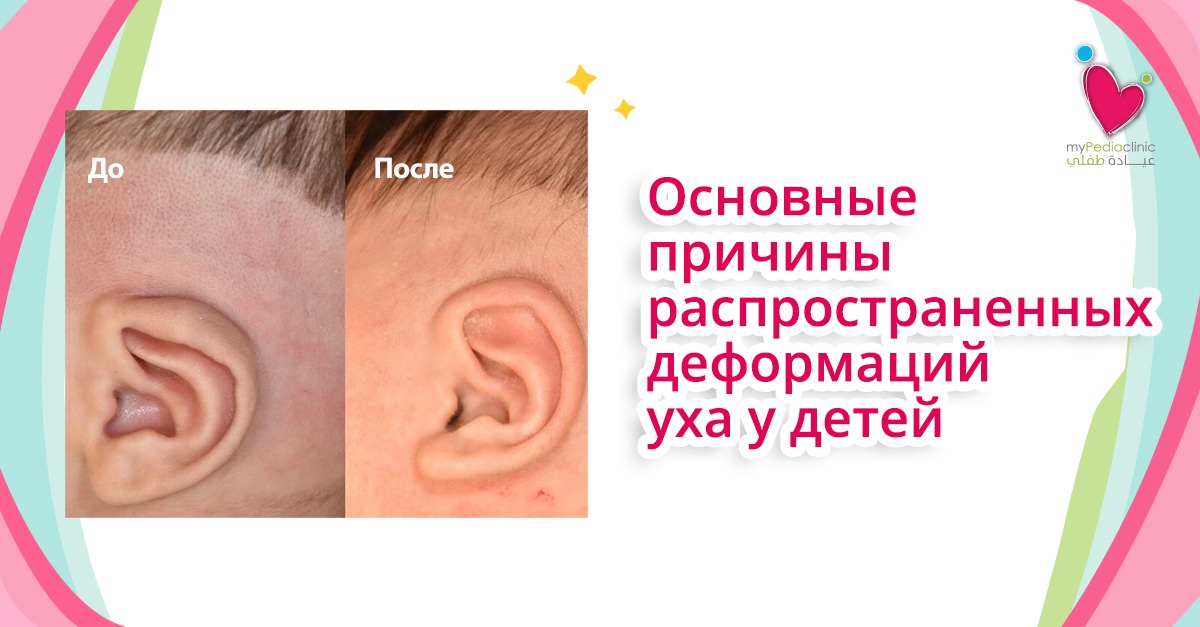 My Pedia Clinic - Main causes of common ear deformities in children