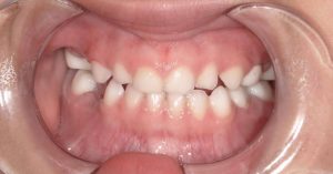 White Crowns for Young Patients 