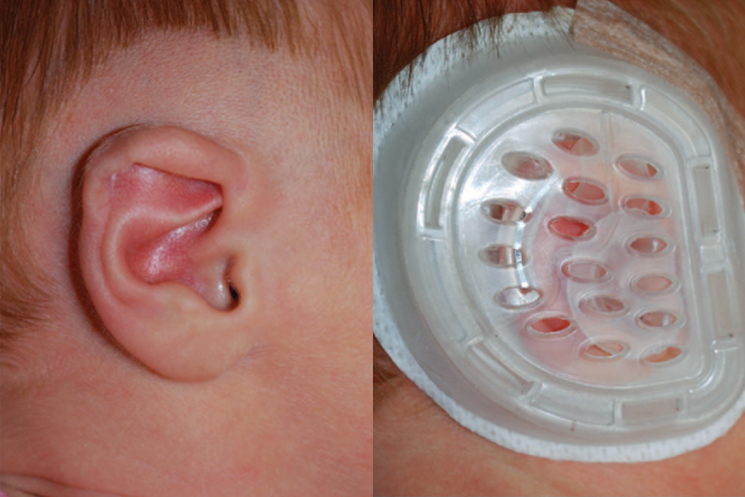 My Pedia Clinic - Ear Molding Banner 2